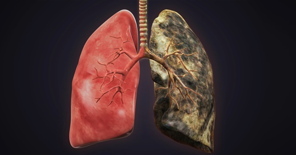 Nurse show the difference between healthy and smoke-damaged lungs